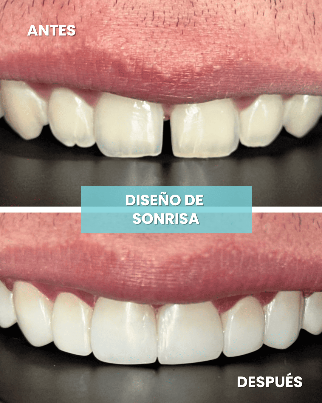 Diseño de sonrisa